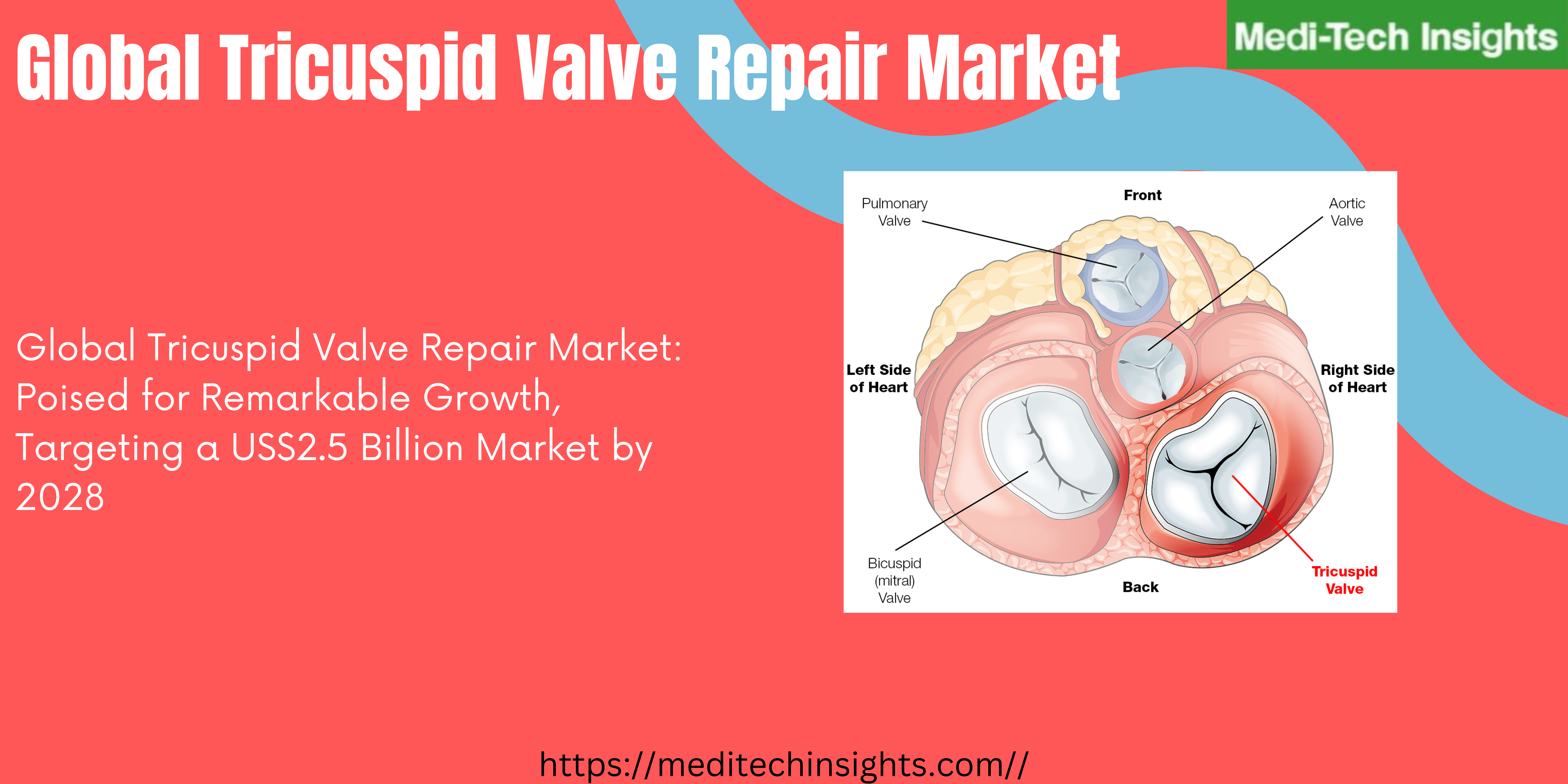 Global Tricuspid Valve Repair Market