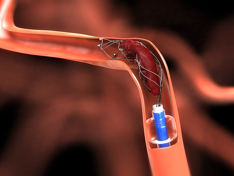 Endovascular Devices Market