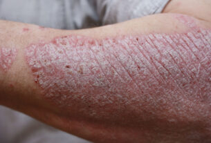 Psoriasis Treatment Market
